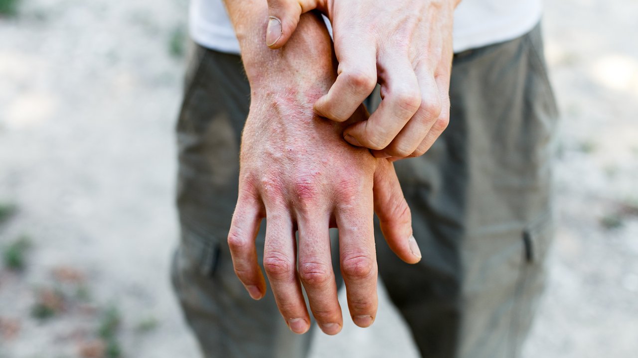 Das Foto zeigt ein Person mit einer allergischen Hautreaktion an der Hand